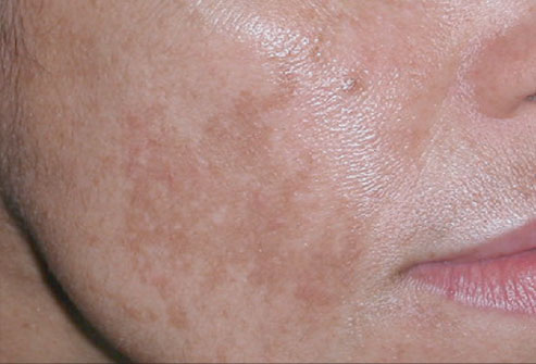 melasma.jpg